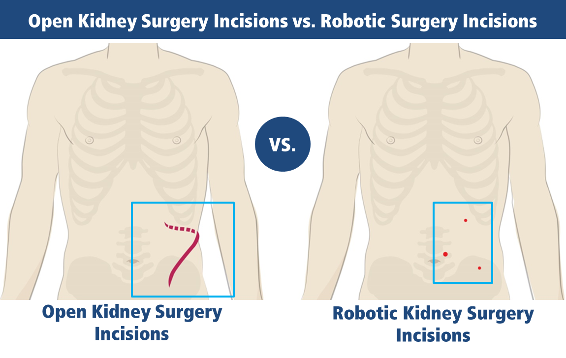 Robotic Urologic Surgery